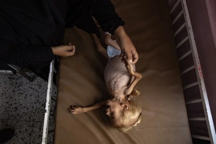 Sham Qudeih, una niña palestina de dos años, yace en una cama del Hospital Nasser de Khan Younis, al sur de la Franja de Gaza